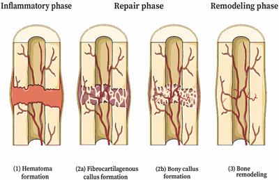 Nanomaterial Nitric Oxide Delivery in Traumatic Orthopedic Regenerative Medicine
